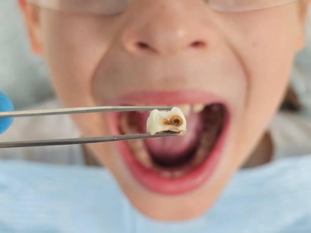 Best Knocked-Out Tooth (Avulsed Tooth) Treatment in Rosendale, WI