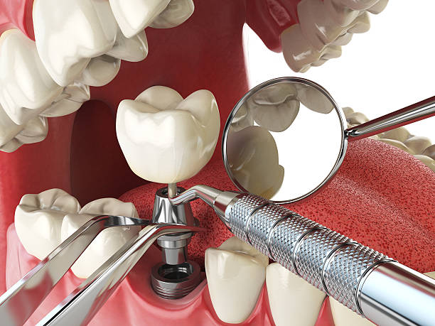 Best Knocked-Out Tooth (Avulsed Tooth) Treatment in Rosendale, WI